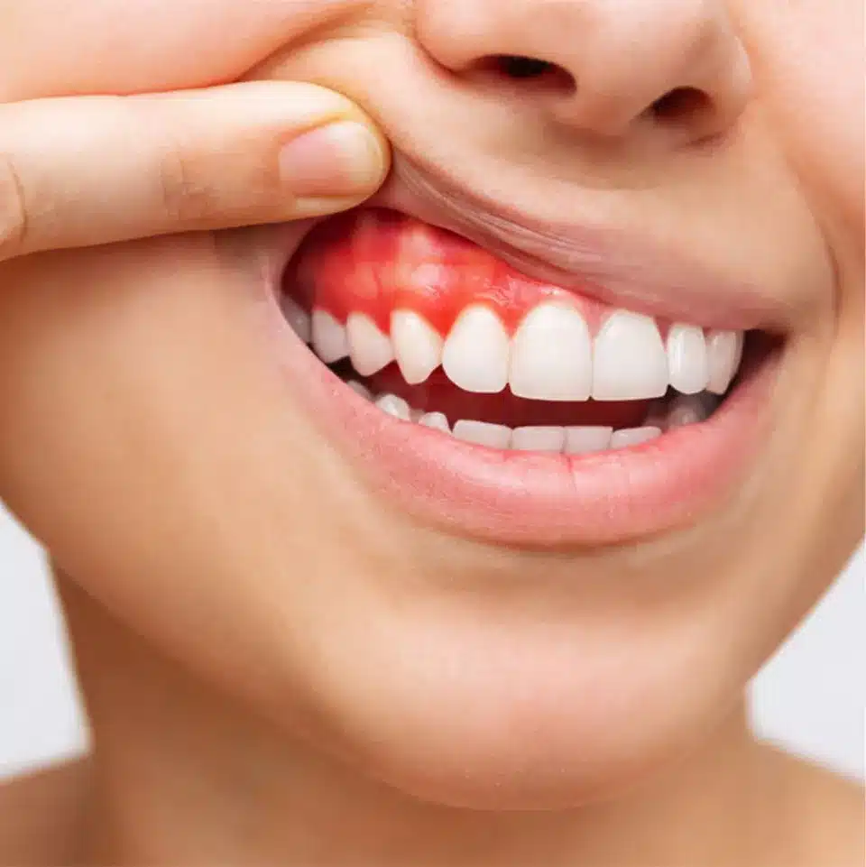 6 dấu hiệu cho biết cơ thể đang thiếu "Collagen" nghiêm trọng